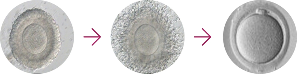 In Vitro Maturation (IVM)